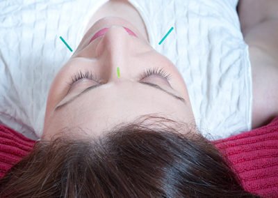 Acupuncture needling