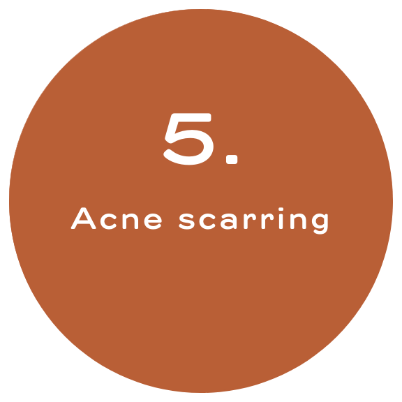 Acne Scarring