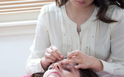 Cosmetic Acupuncture for Wrinkles