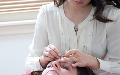 Cosmetic Acupuncture for Wrinkles