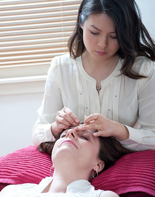 Cosmetic Acupuncture for Wrinkles