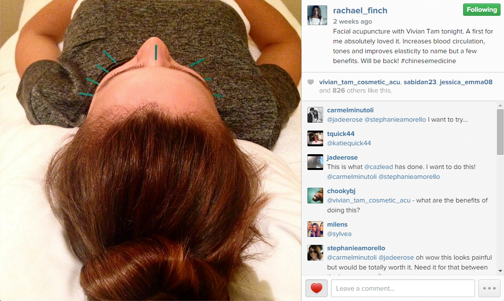 Rachael Finch has Cosmetic Acupuncture with Dr. Vivian Tam