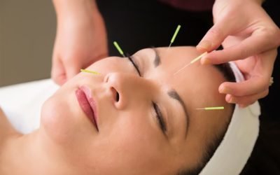 Everything you need to know about Cosmetic Acupuncture