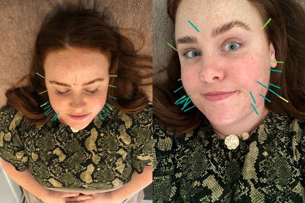 TRIED AND TESTED: I had cosmetic acupuncture, the ancient ‘cure all’ beauty treatment.