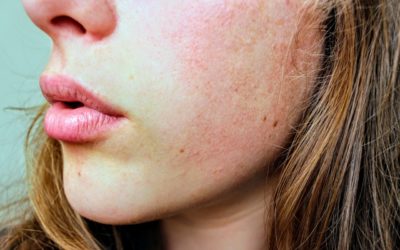 How an ancient Chinese medicine is being used to ‘cure’ facial acne