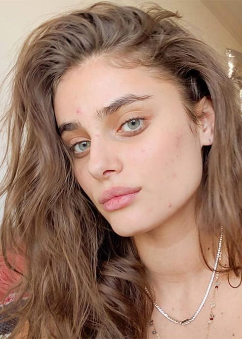 How to get your hormonal acne under control